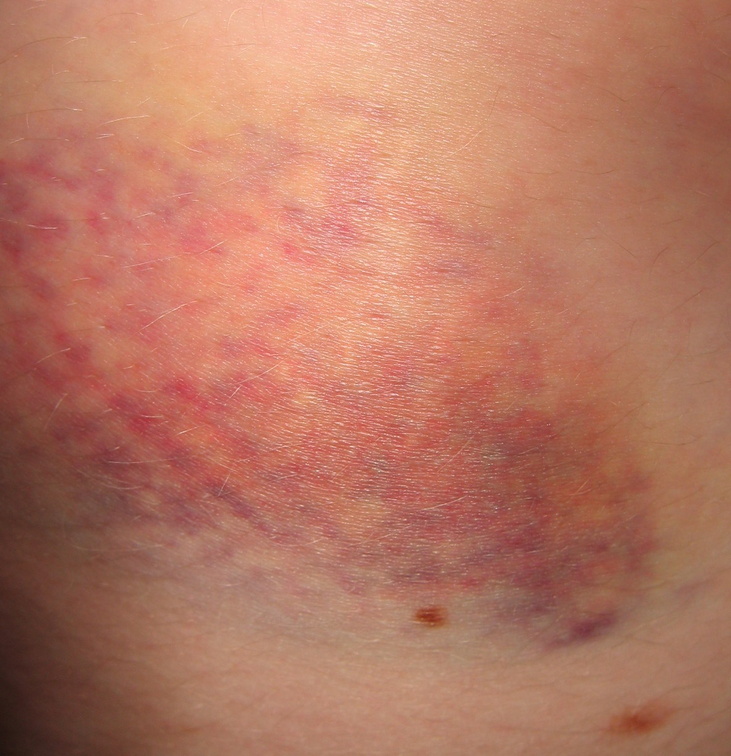 bruise 24 hours