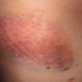 bruise 24 hours